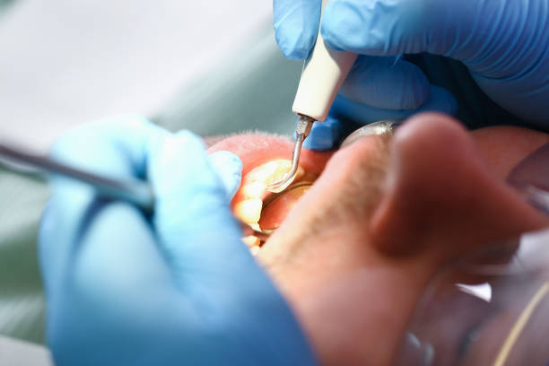 Best Emergency Dental Care for Broken or Chipped Teeth in Glenside, PA